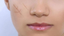 Yara Belirtileri ve Tedavisi Yara Belirtileri ve Tedavisi