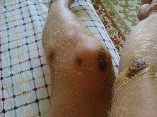 Dizde Yara Belirtileri ve Tedavisi Dizde Yara Belirtileri ve Tedavisi