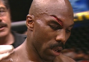 Kaş Yarılması Belirtileri ve Tedavisi Kaş Yarılması Belirtileri ve Tedavisi